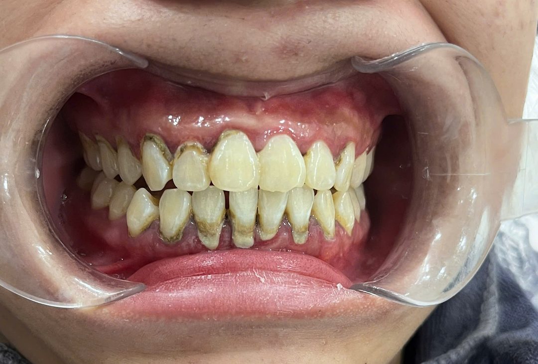 Răng trước khi lấy cao răng, cao răng ố vàng bám nhiều